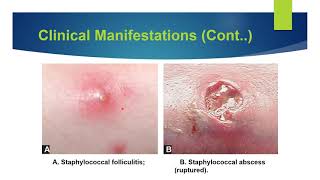 Staphylococcal Infections [upl. by Clarise]