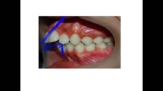 classification of malocclusion part 2 [upl. by Carbo]