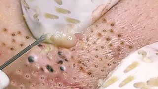 Big Cystic Acne Blackheads Extraction Blackheads amp Milia Whiteheads Removal Pimple Popping [upl. by Durr]