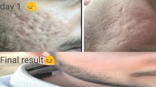 Dermabrasion treatment in hindi । India [upl. by Lacefield554]