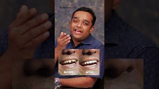 അര മണിക്കൂറിൽ പല്ല് ശെരിയാക്കാം dentalclinic dentaltips dentalcrowns dentalveneers smile [upl. by Niran]