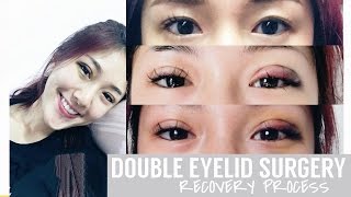 NonInvasive Double Eyelid Procedure  Recovery Process  FATFOAL [upl. by Haroppizt]