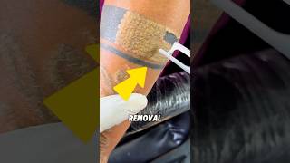 Laser Tattoo Removal Process [upl. by Asum927]