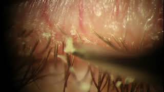 Demodex Blepharitis Plaque Removal with Forceps  Eyelash Mite at 539 [upl. by Shuler562]