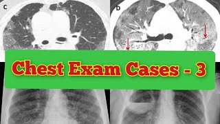 Radiology Viva Cases  149155  Chest Exam Cases Part 3 medical radiology ultrasound doppler [upl. by Lezirg116]