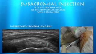 Ultrasound guided Subacromial injection from probeultrasoundcom [upl. by Luisa338]