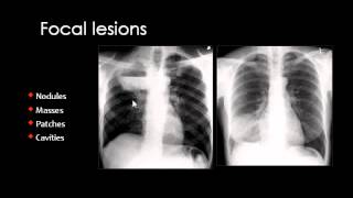 Chest XRay CXR in Arabic  Prof Mamdouh Mahfouz [upl. by Ecyrb]