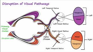 Visual Field Defects Meyers Loop amp Dorsal Optic Radiation [upl. by Eirrahs]