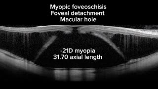 Cirurgia de vitrectomia com “fovea sparing ILM peeling” [upl. by Elleret]