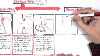 Bowel Obstruction  Causes and Pathophysiology [upl. by Eiuqnom]