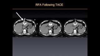 UCSF Radiology Killing Cancer Tumors w Radiofrequency Ablation Therapy [upl. by Kentiggerma]