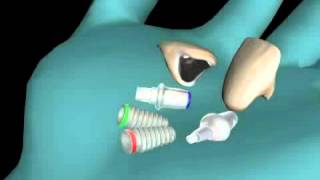 Zirconia prosthesis the ultimate solution for missing teeth [upl. by Nosoj]