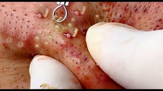 Pimple popping videos of 2021  Squeezing exploding acne Compilation [upl. by Meraree43]