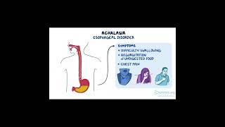 Achalasia A Disorder of the Esophagus health [upl. by Nisbet257]