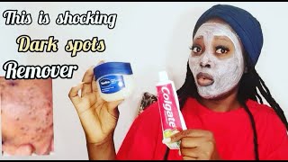 How To Use Colgate And Vaseline To Get Rid Of Dark Spots On The Face Very Fast Results [upl. by Nauqe]