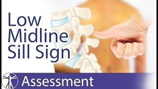 Low Midline Sill Sign  StepOff Sign  Slipping Palpation  Spondylolisthesis [upl. by Brandwein]