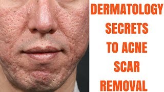 Acne scar treatments ULTIMATE GUIDE [upl. by Kcirdet]