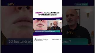 Rosacea Tedavi Edilmezse Ne Olur Uzm Dr Şerafettin Saraçoğlu [upl. by Nirik597]