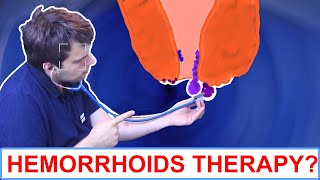 4 Things To Do About Hemorrhoids [upl. by Artinek]