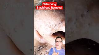 Crazy BLACKHEAD REMOVAL  Blackhead Extraction shorts [upl. by Aisya]