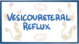 Vesicoureteral reflux  causes symptoms diagnosis treatment pathology [upl. by Pol623]