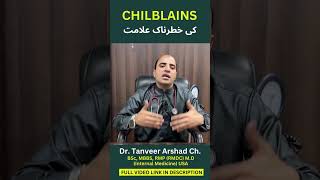 What are the danger signs of chilblains  چلبلینز کے خطرے کی علامات؟  Dr Tanveer Arshad Ch [upl. by Akienom]