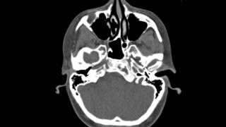 Fibrous Dysplasia Clivus [upl. by Atwahs]