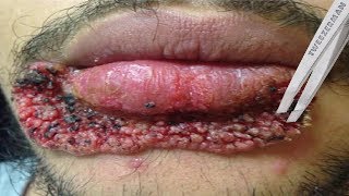 Worst Lip Pimples on YouTube [upl. by Phelan]