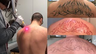 Laser Tattoo Removal  The Ugly Truth [upl. by Llahsram]