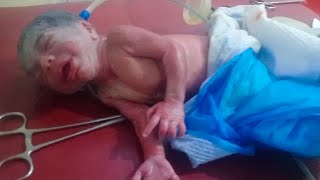 New born very premature baby camein gasping condition take action thanks God baby save after proces😥 [upl. by Anatnas723]