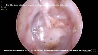 Grade IV Tympanic membrane retraction [upl. by Raval]