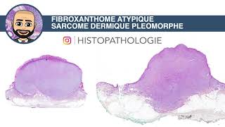 Fibroxanthome atypique amp sarcome pleomorphe dermique [upl. by Rush]