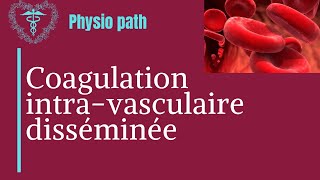 CIVD Coagulation intravasculaire disséminée [upl. by Caddric]