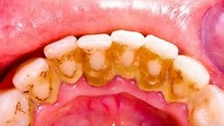 HOW TO REMOVE DENTAL PLAQUE IN 5 MINUTES NATURALLY WITHOUT GOING TO THE DENTIST [upl. by Marthena]