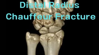 Distal radius fracture Chauffeurs fracture [upl. by Moriarty512]