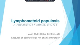 6 Lymphomatoid Papulosis  A Frequently Missed Entity [upl. by Memberg905]