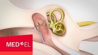 Mixed Hearing Loss Sensorineural and Conductive Hearing Loss  MEDEL [upl. by Hampton]