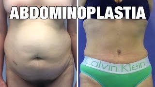 Abdominoplastia en Mujeres  Antes y después  Experiencia Flor [upl. by Pine]