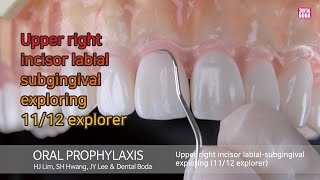 Upper right incisor labial subgingival exploring 1112 explorer [upl. by Icyac]