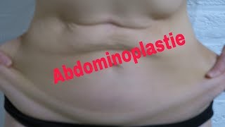 ABDOMINOPLASTIE JOUR 1 2 et 3 [upl. by Hares67]