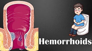 Hemorrhoids  Types Causes Risk Factors Signs amp Symptoms Diagnosis amp Treatment [upl. by Anor972]