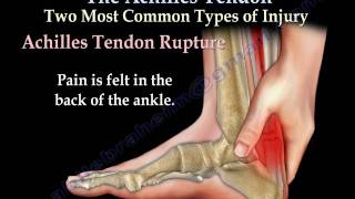 Achilles Tendon rupture tear tendonitis  Everything You Need To Know  Dr Nabil Ebraheim [upl. by Enedan104]