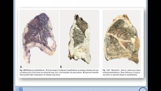 Prof JFのレクチャー e learning 2017519 prof Fukuoka part 2 mesothelial cell pathology [upl. by Ylac848]