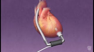 Mayo Clinic Minute How ventricular assist devices can help heart patients [upl. by Laverne651]