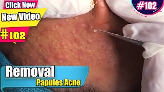 Removal Papules Acne Under Skin Clients  Acne Treatment 102 [upl. by Adnorhs]