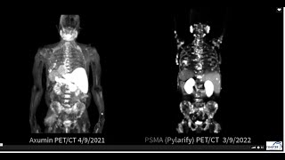 Axumin VS Pylarify PSMA PETCT [upl. by Rinaldo588]