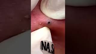 Pimple Popping Blackhead Extraction 2024 [upl. by Noired600]