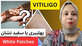 سکن پہ سفید داغ اور پھلبیری میں فرق White Patches And Vitiligo Treatment [upl. by Evangelist]