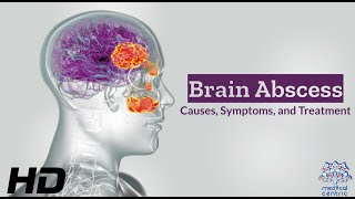 Brain Abscess Unveiled Causes Symptoms and Lifesaving Treatments [upl. by Kentigera371]