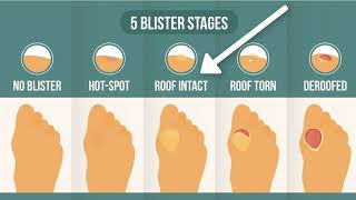 How To Treat A Blister Correctly First Look At Your Blister Roof [upl. by Akirdna]